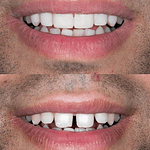 Before and After Invisalign mouth